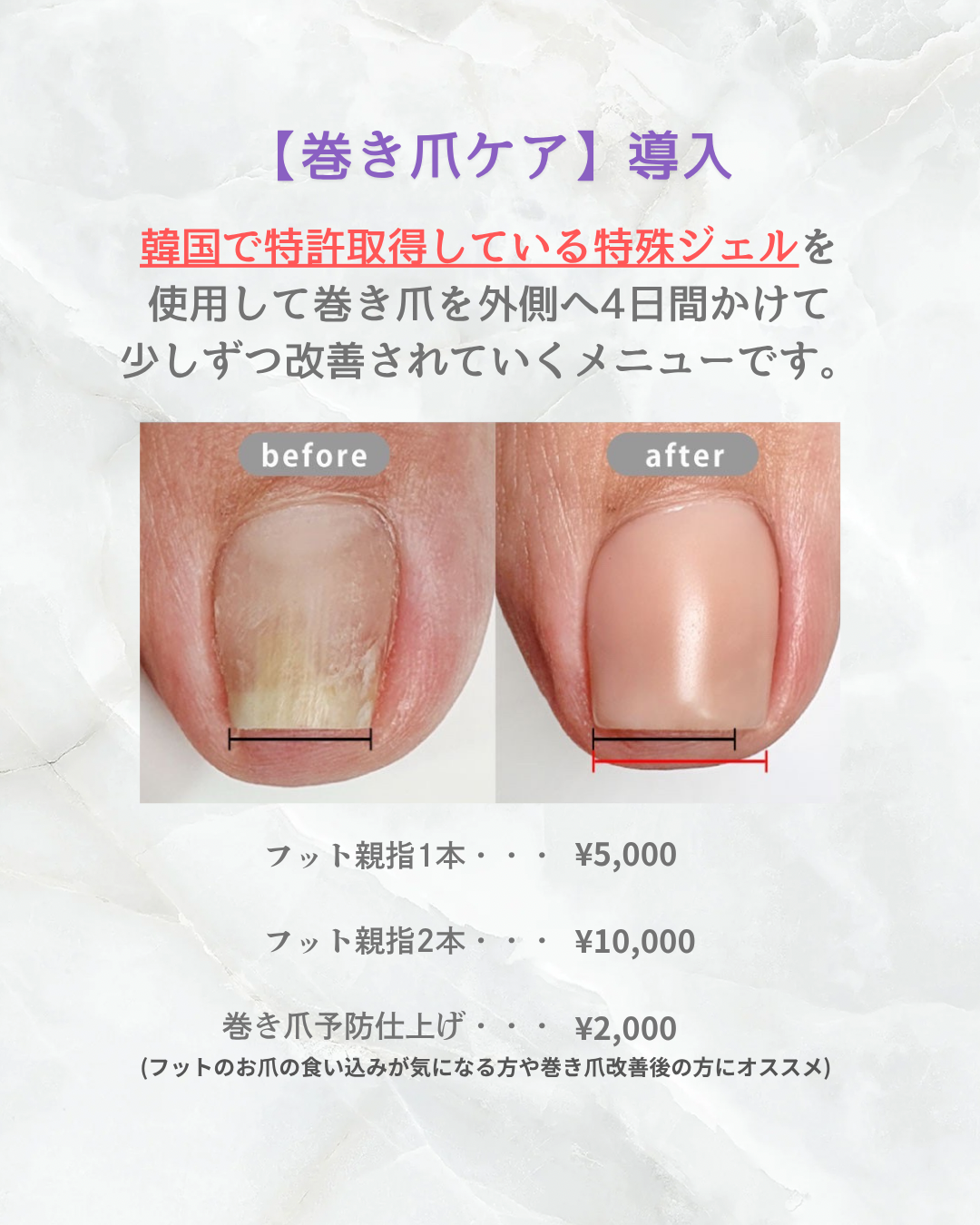 巻き爪ケア導入